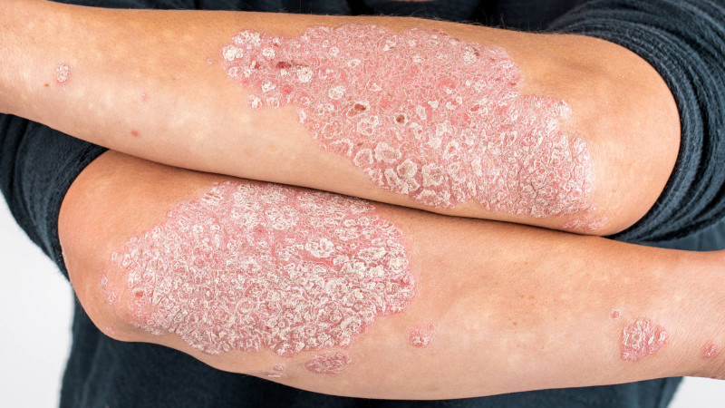 Psoriasis