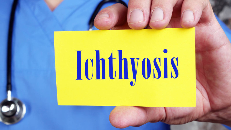 Ichtyosis